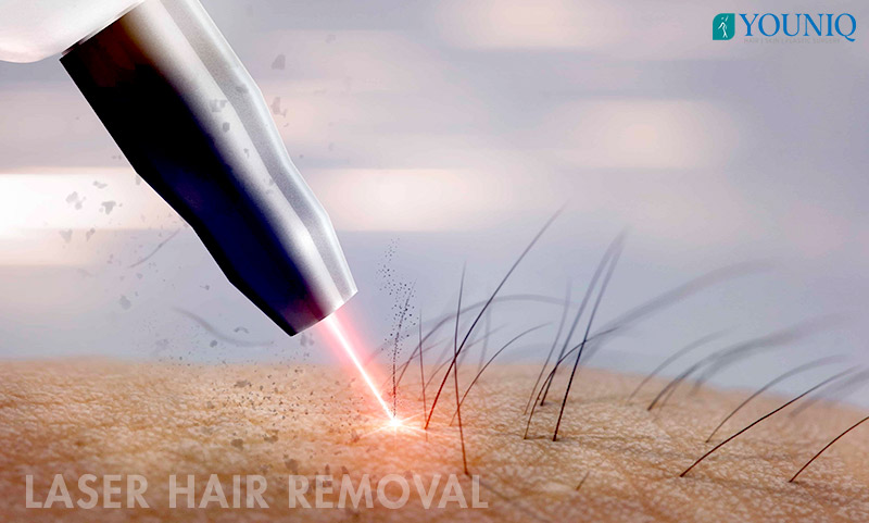 Laser Hair Removal HyderabadBest Laser Hair Removal