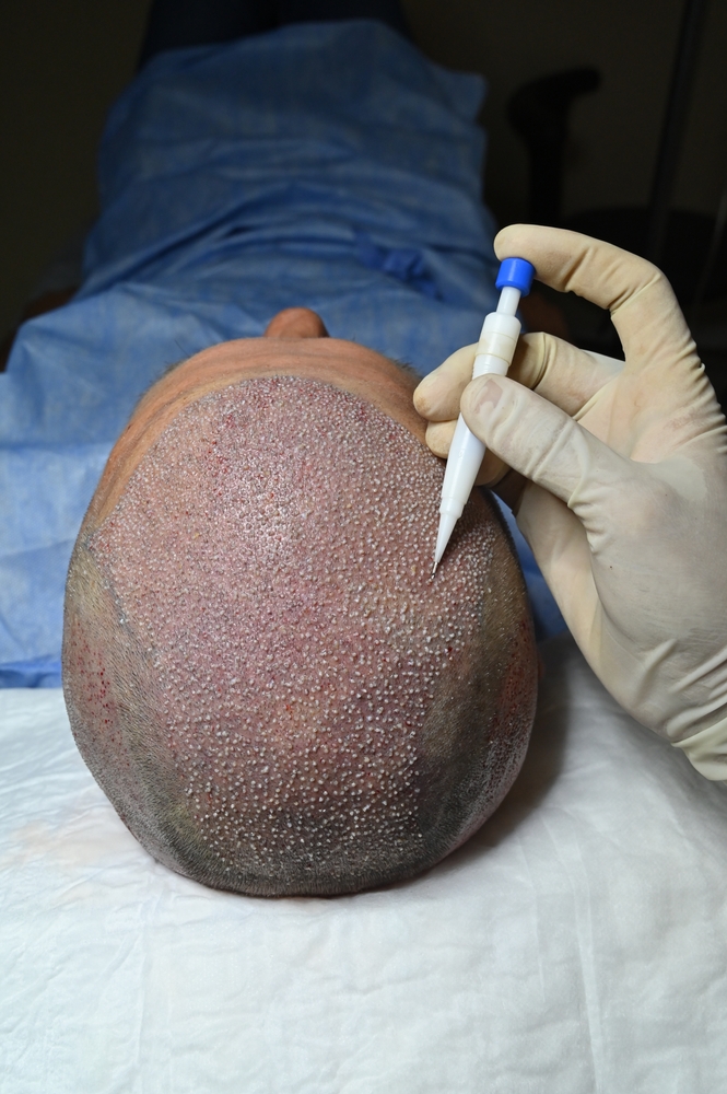 Hair,Transplantation,With,Dhi,Technique