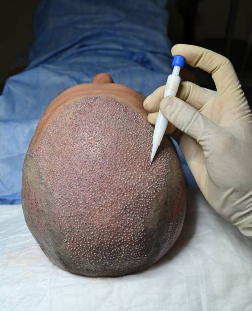Hair Transplantation in jubilee hills Hyderabad