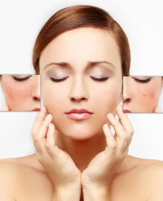 Effective laser pigmentation removal to reduce dark spots and uneven skin tone.